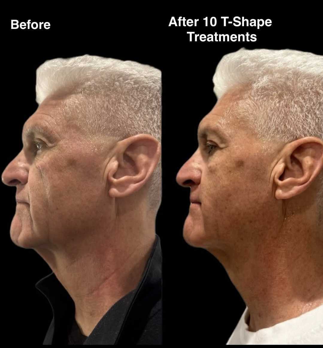 T-Shape 2 face and neck lifting before and after 10 treatments at iCRYO Boca Raton