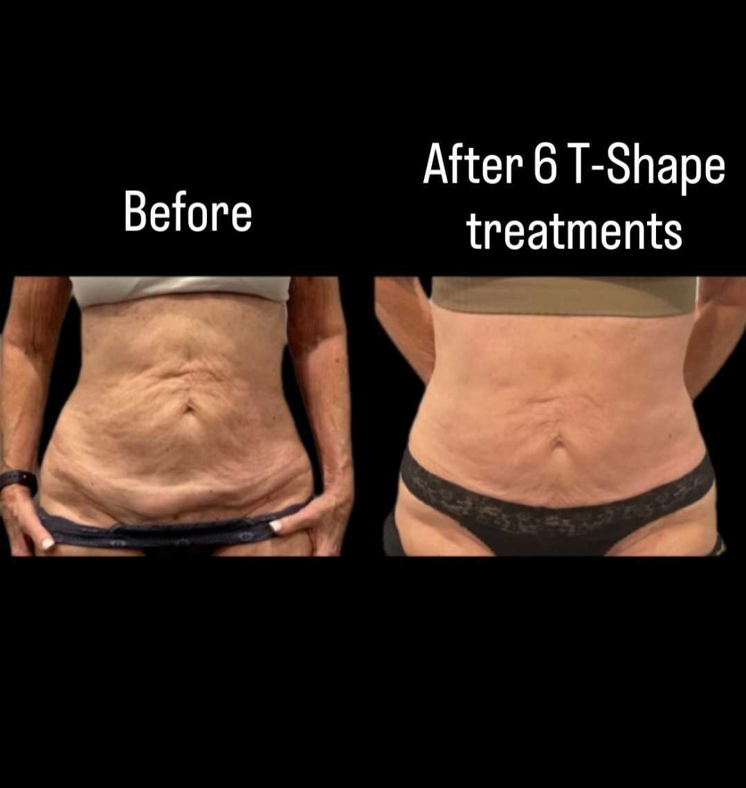 T-Shape 2 abdomen skin tightening before and after 6 treatments at iCRYO Boca Raton