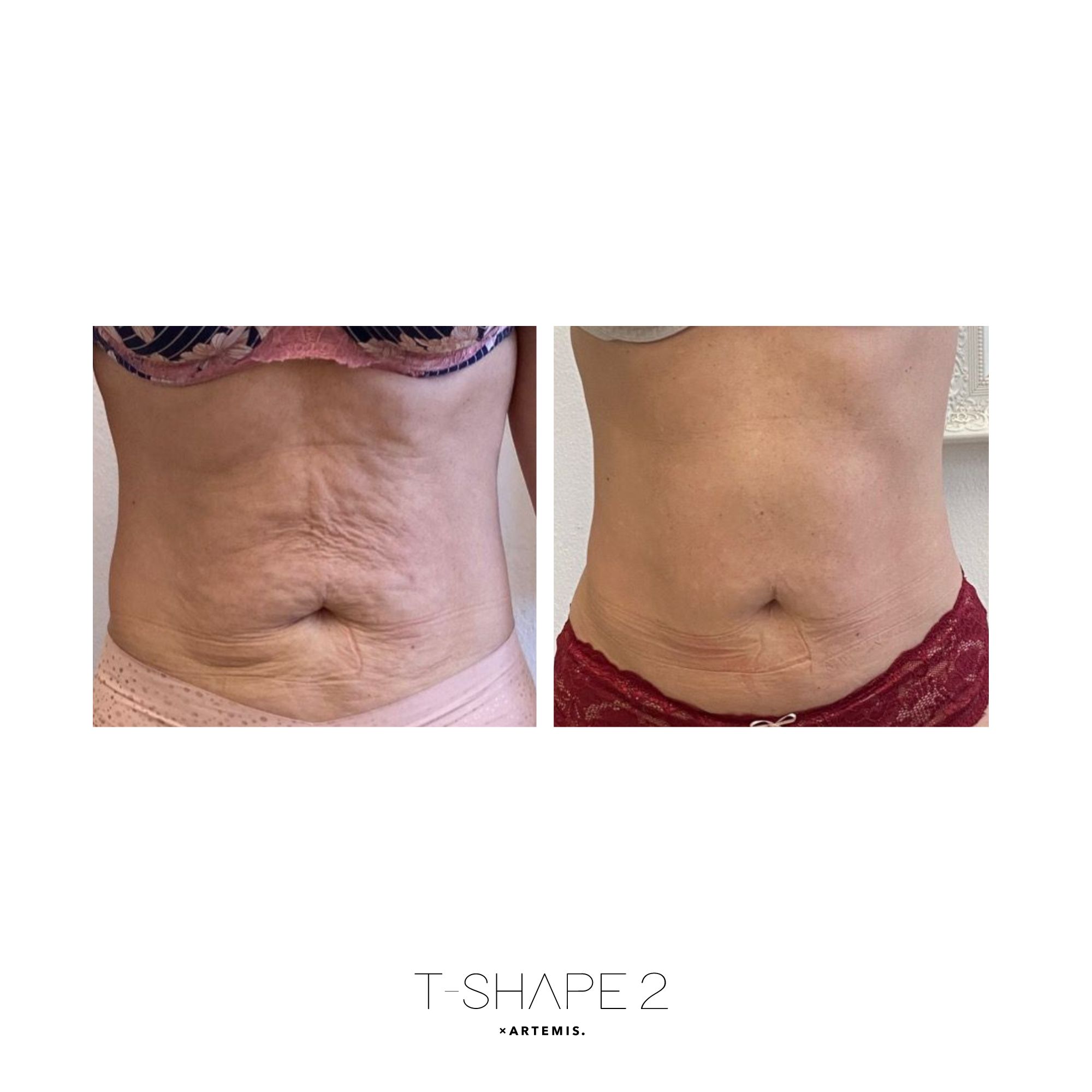 T-Shape 2 abdominal contouring results after a treatment series at iCRYO Boca Raton
