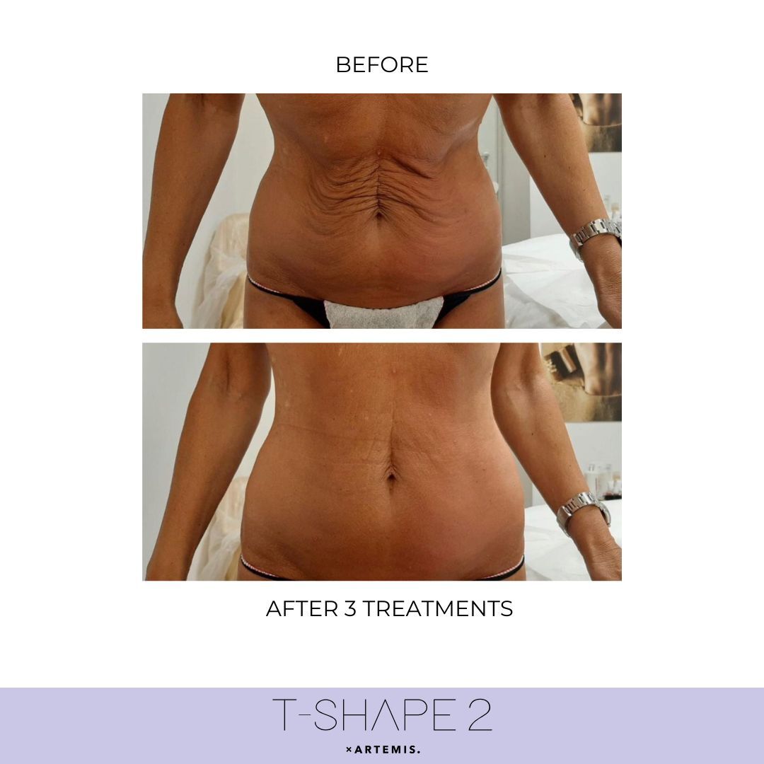 T-Shape 2 abdomen results after 3 treatments at iCRYO Boca Raton