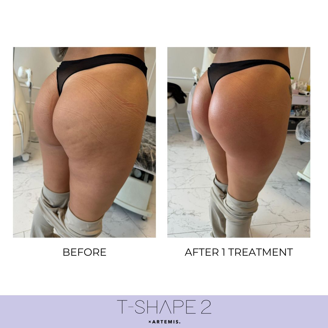 T-Shape 2 body contouring results after 1 treatment at iCRYO Boca Raton