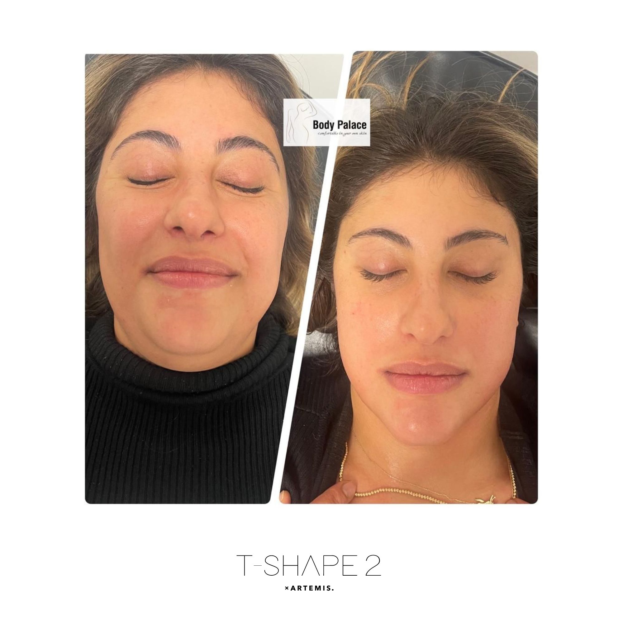 T-Shape 2 facial rejuvenation results after 4 treatments at iCRYO Boca Raton