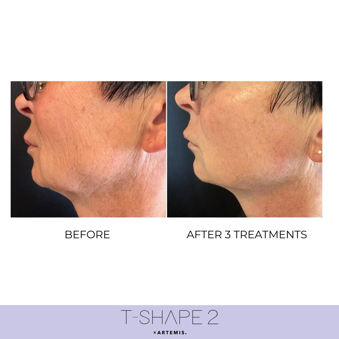T-Shape 2 face tightening results after 1 treatment at iCRYO Boca Raton