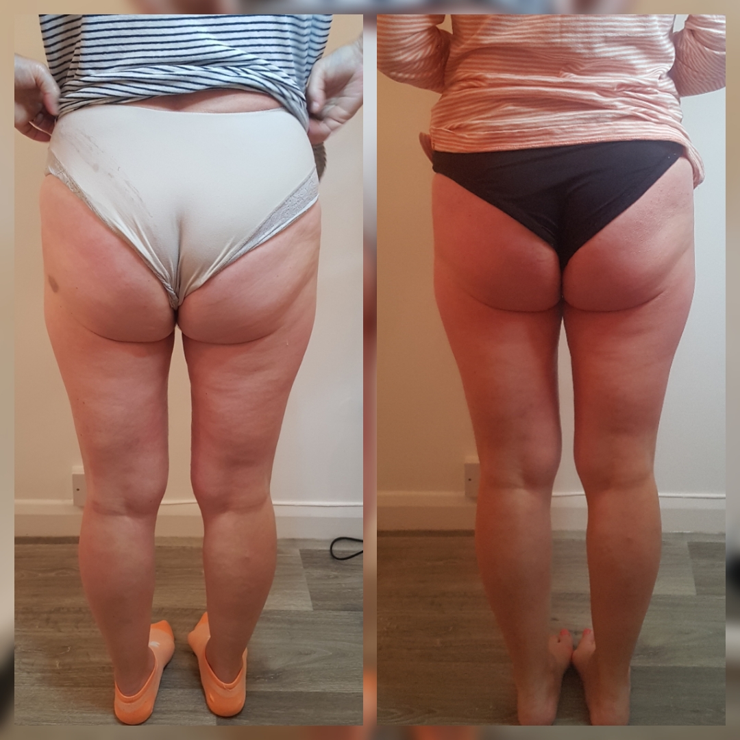 T-Shape 2 glute sculpting results after a treatment series at iCRYO Boca Raton